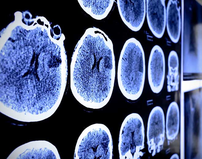 Brain scan medical imaging results