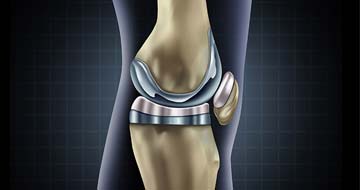 Knee joint with implant illustration